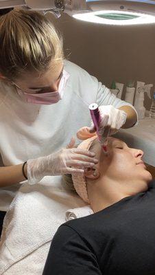 Microneedling Treatment