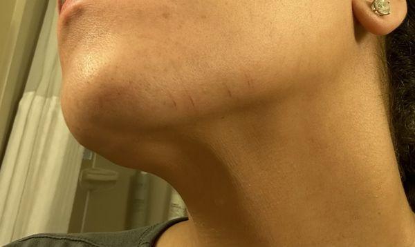 Photo of cuts on my face from dermaplane facial at Heather Brown.