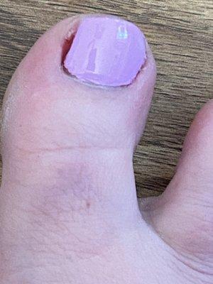 "Ingrown toenail"