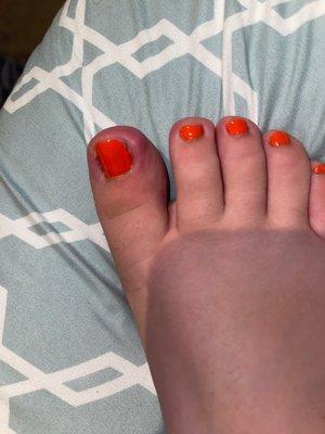 Infected toe a week later