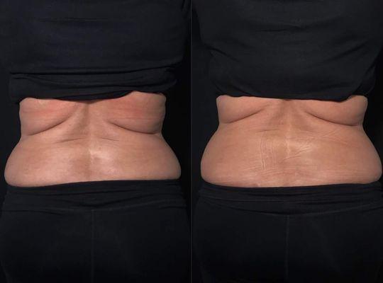 Results immediately after Non-Invasive Laser Lipo