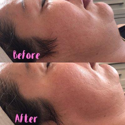 Dermaplaning Before and After