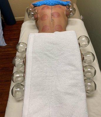 Cupping Therapy