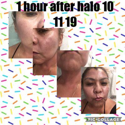 1 hour after having Halo procedure