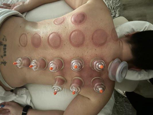 Cupping massage