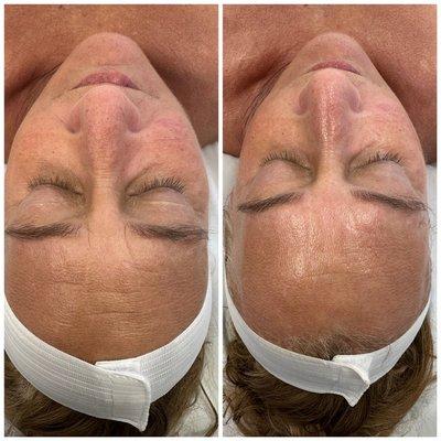 Brightening facials