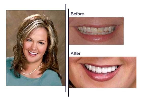 Heather is a lovely wife and mother.  She wanted her teeth healthy and beautiful, so her kids would be proud when she smiles.