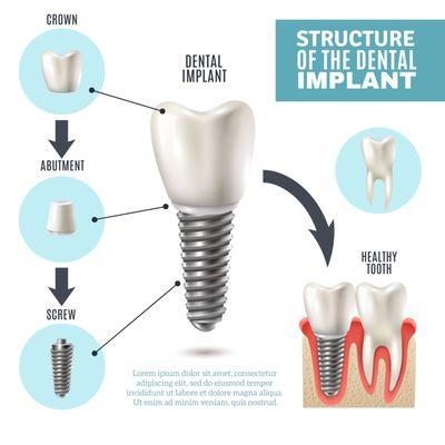 Dental implant procedure.