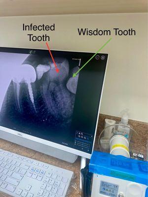 X-ray of infected tooth and wisdom tooth