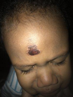 This is the cut on my child's head the daycare said they didn't know what happened DO NOT SEND YOUR CHILD HERE!!!