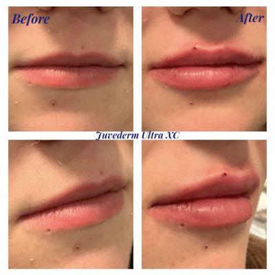 Lip filler/augmentation with Juvederm Ultra XC. Beautiful natural looking enhancement of the lips.