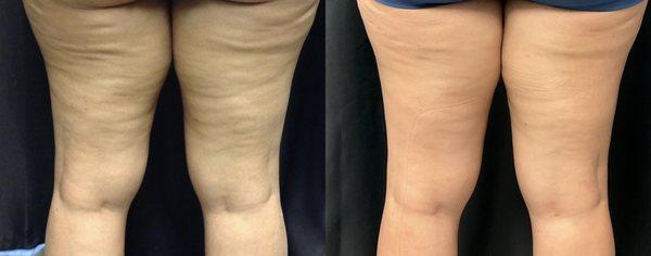 Cellulite reduction