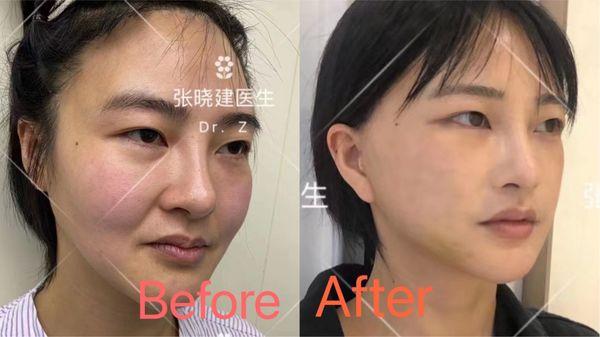 Results of china doctor on a young woman  She is young but messed with her face just like I did  Luckily he was able to fix her back