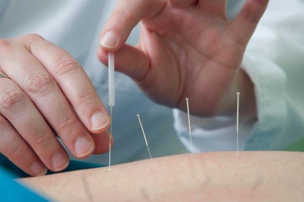 Acupuncture