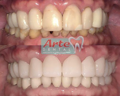 Cosmetic full mouth rehab.