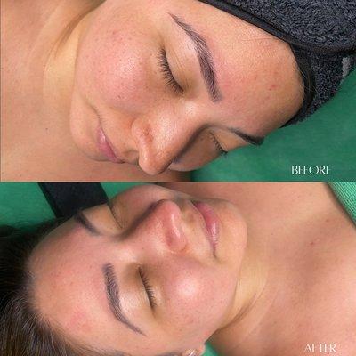 Dermaplane Facial