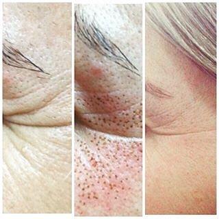 Crows Feet Fibroblast Plasma Treatment. Amazing Results! Contact us at (208)999-5445