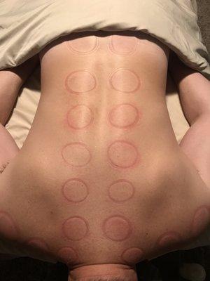 Massage cupping also works the fascial tissue of the body.