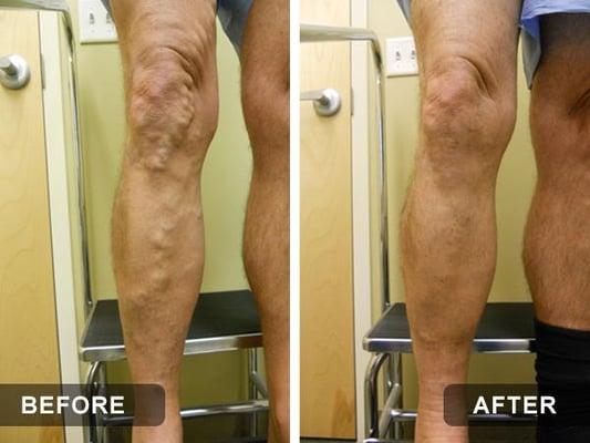 BEFORE & AFTER LASER ABLATION