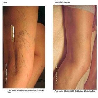 Before and After- Laser Vein Removal