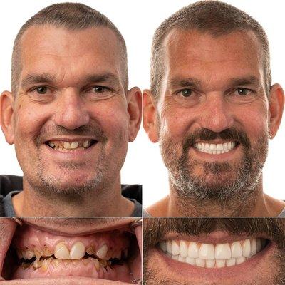 Beautiful before/after with Full Mouth Implants