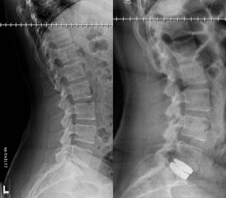 Lumbar Disc Replacement