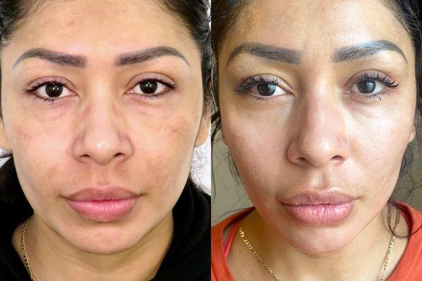 Jet Plasma treats Melasma. Results  after 7 Treatments. Full Face and Neck was treated which also helped to define and contour her face.