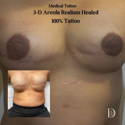 This is a breast cancer survivor client. She was treated with 3D areola realism tattoo.