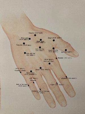 Hand acupuncture