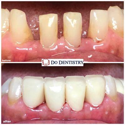 Patient was unhappy with the spaces in between their teeth! We delivered four all ceramic crowns for the lower teeth