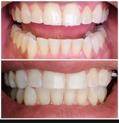 Brightens Teeth Whitening