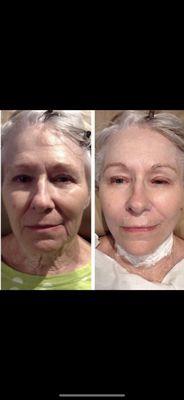 Before and after our anti-aging treatments