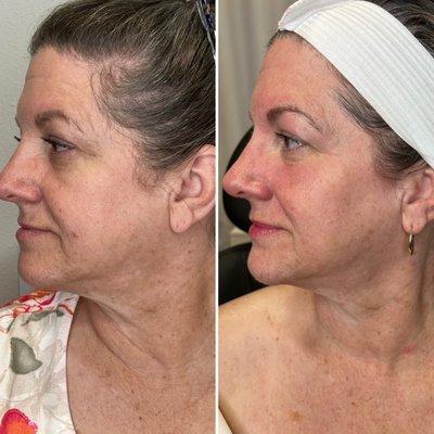 Before and after one SkinPen Microneedling treatment!