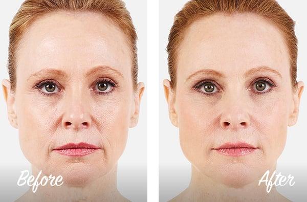 Juvederm filler Before & After Photo