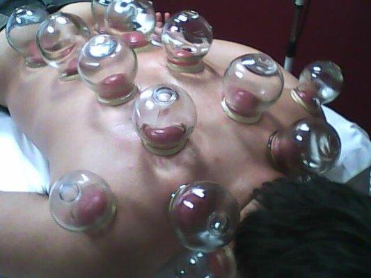 Cupping for back pain