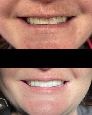 Smile makeover done by Dr. Dawood