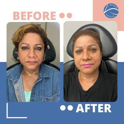 Client transformation using our Triple Threat service for skin tightening and addressing hyperpigmentation!

Book your appointment today.