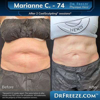 Marianne after 2 CoolSculpting sessions!