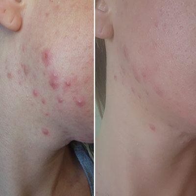 Before and After 
Acne Facial Treatment