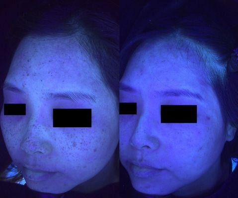 Picoway hyperpigmentation removal