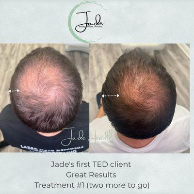 Hair restoration with TED.  No needles. No pain. Just results!