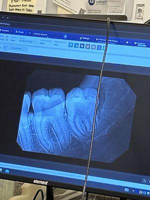 Infected wisdom tooth needing extraction