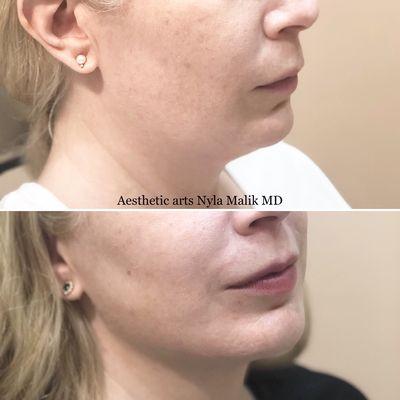 Kybella treatment  for chin fat area and jawline contouring