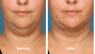 Kybella before and after