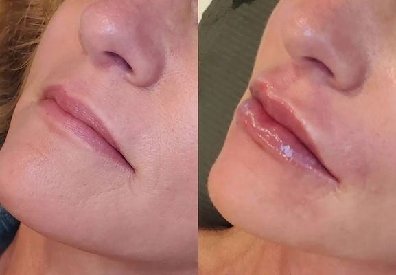 Needleless/painless filler