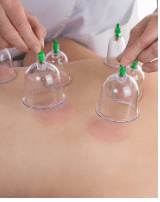 Cupping