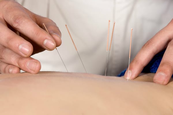 Acupuncture Treatment