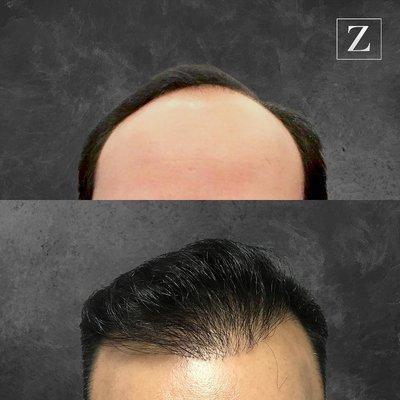 Male Hair Rejuvenation - FUE FUT