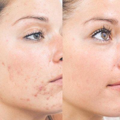 Skin Care before & after