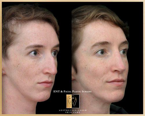 Rhinoplasty Hump Reduction